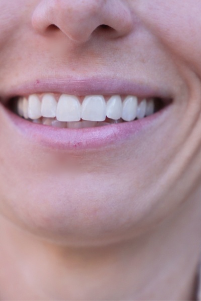 {6} Facts You Didn't Know About At-Home Teeth Whitening Smile Brilliant Tray Teeth Whitening